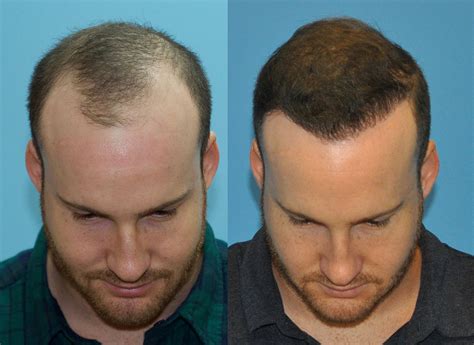 Hairline Restoration Of Year Old Male Norwood Class Iii Hair