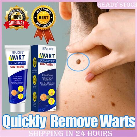 Original Warts Remover Cream Remove Common Warts Filamentous Warts Flat