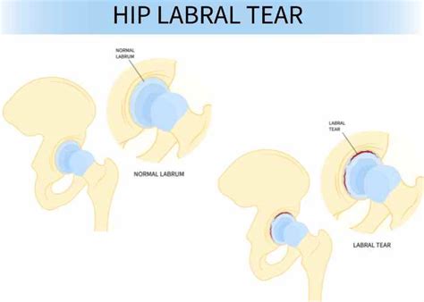 Torn Hip Labrum Labral Tear Orthopedic Hip Specialist Sugar Land