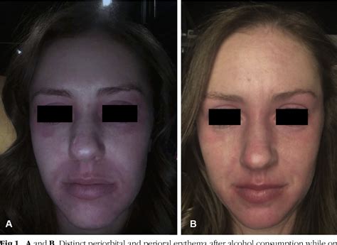 figure 1 from alcohol induced facial flushing in a patient with atopic dermatitis treated with