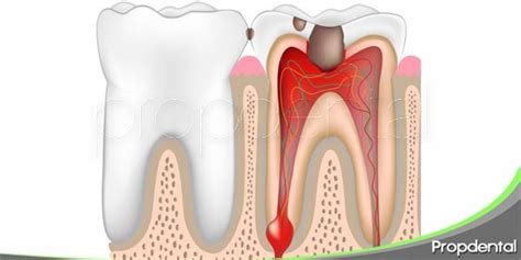 ¿qué Es La Pulpitis Dental Tratamiento De La Pulpitis En Una Muela