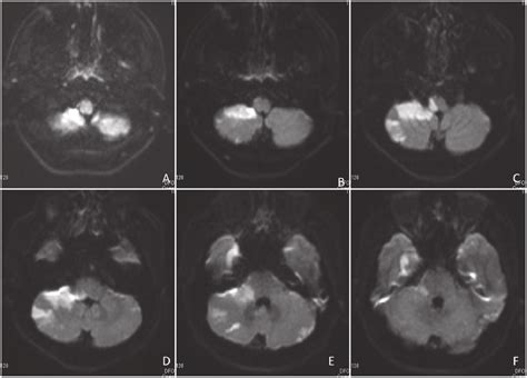 A Diffusion Weighted Mr Image Reveals Some High Intensity Lesions