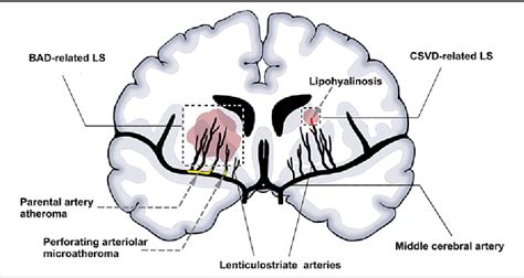 Figure From Advances In Understanding The Pathogenesis Of Lacunar Stroke From Pathology And