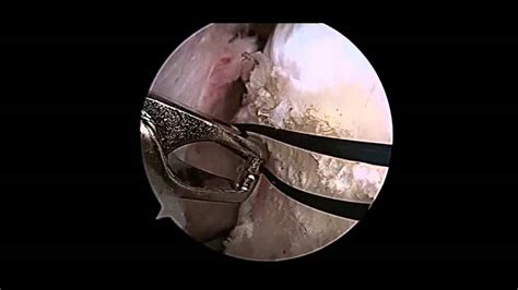 Advances In Hip Capsular Management Youtube