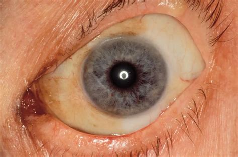 Primary Acquired Melanosis American Academy Of Ophthalmology