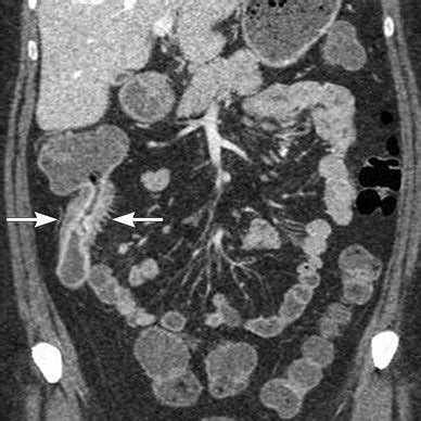 8Normal Mitrofanoff Continent Urostomy Axial CT Cystogram In A Patient
