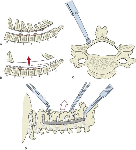 Subaxial Cervical Spine Trauma Musculoskeletal Key