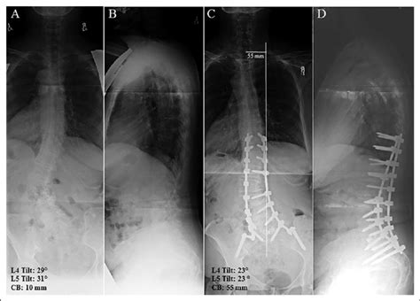 Preoperative Standing Anteroposterior A And Lateral B Radiographs