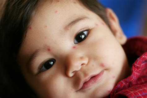 Chicken Pox Vaccination In A Nutshell Dr Sanjay Wazir Sector 47