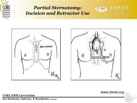 Ppt Ribs Post Sternotomy Pain Powerpoint Presentation Free Download