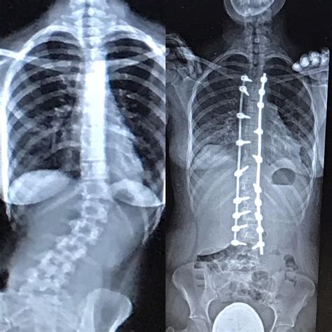 Before And After Pics From My Surgery 62619 Rscoliosis