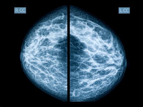 Abnormal Mammogram 7 Questions To Ask Your Doctor The Healthy