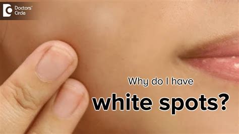 What Is The Cause Of White Spots On The Skin Dr Rasya Dixit Youtube