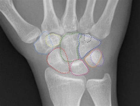 Emrad Radiologic Approach To The Traumatic Wrist