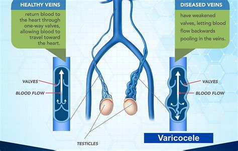 Varicocele Embolization Day Care Treatment For Varicocele A Silent