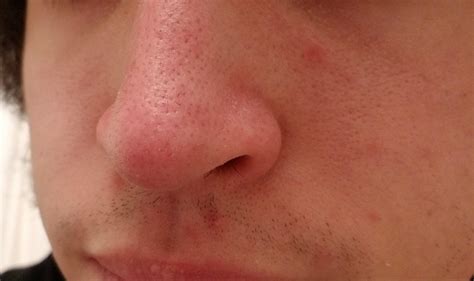I Hate My Nose Area Any Ways To Improvefix It Skin Concerns R