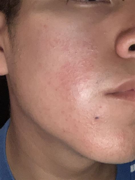 Help Is This Rosacea Or Acne Rosacea And Facial Redness