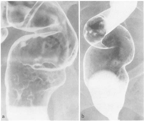 Barium Enema And Defaecography In The Diagnosis And Evaluation Of The