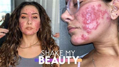 My Cystic Acne Started At Shake My Beauty Youtube