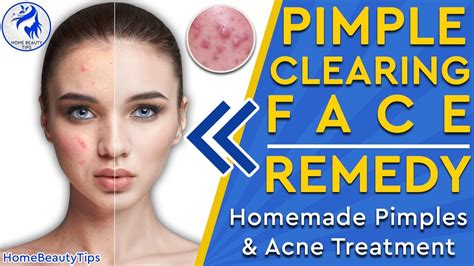 How To Remove Pimples Get Rid Of Pimples Remedy For Pimples Acne
