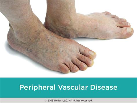Pad Symptoms Complications Vascular Peripheral Artery