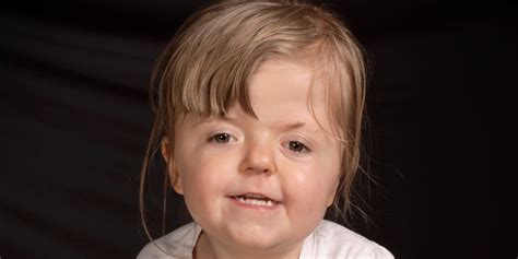Apert Syndrome Diagnosis What Doctors Don T Tell You