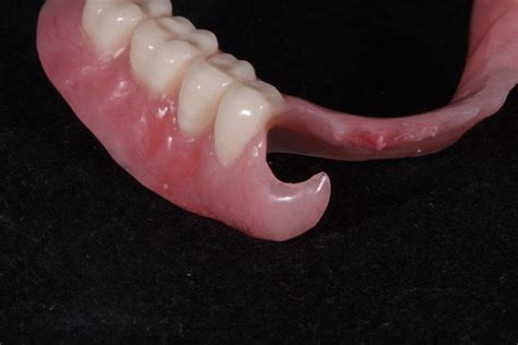 Acrylic Based Partials Williams Dental Lab