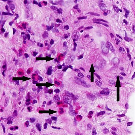 Eosinophilic Granulomatosis With Polyangiitis Clinical Pathology