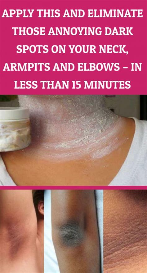 Apply This And Eliminate Those Annoying Dark Spots On Your Neck