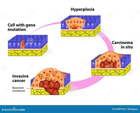 Developmental Phases Of Cancer Stock Vector Illustration Of Membrane