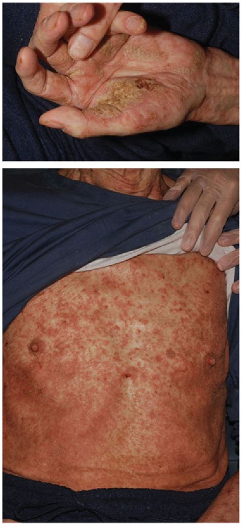 Figure From Abstract Scabies Is An Infection Caused By Sarcoptes