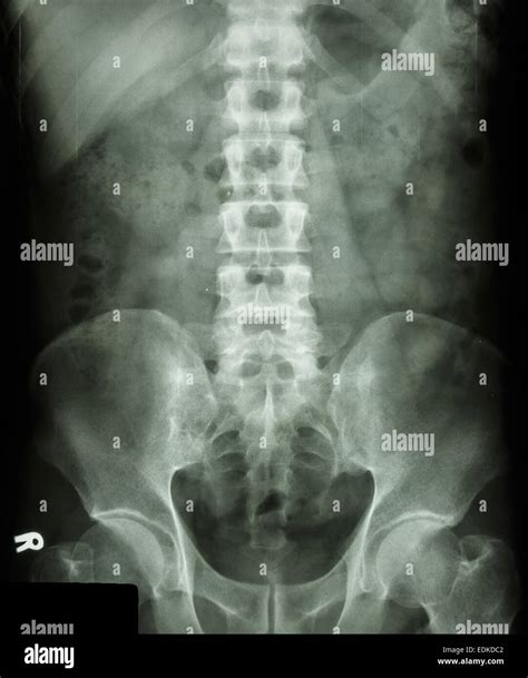 Film X Ray L S Spine Apantero Posterior Show Normal Humans