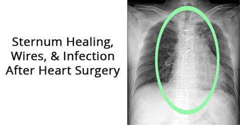 Sternum Healing Wires And Infection After Heart Surgery