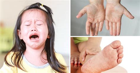 Hand Foot Mouth Disease What You Need To Know Wah Choi Pharmacy