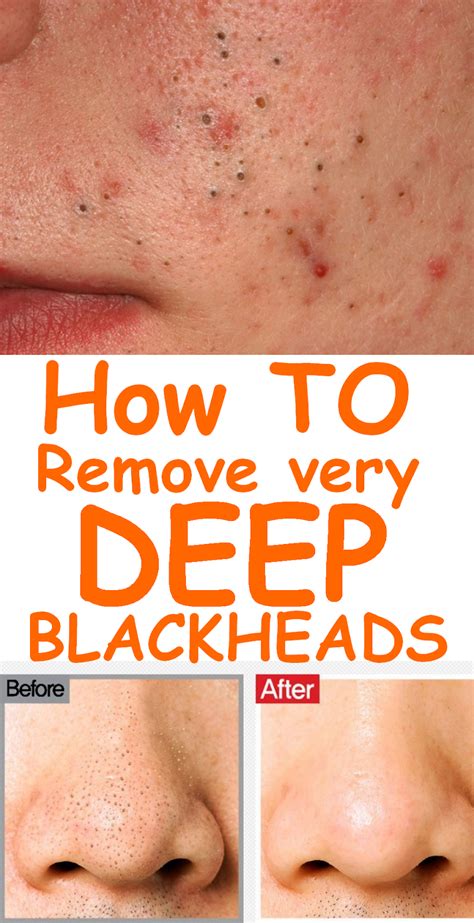 How To Get Rid Of Deep Blackheads On Nose 10 Home Remedies Healthy Tray
