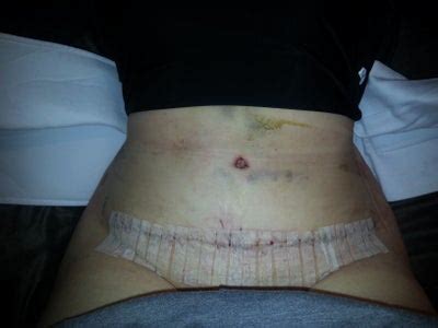 Avelar tummy tuck pictures, before & after gallery pictures, photos for avelar tummy tuck performed by hamilton surgical arts, marion, in. The Beginning of a New Me... - Bellevue, WA - Tummy Tuck ...