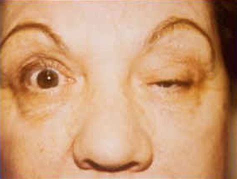 Development of a thymectomy trial in nonthymomatous myasthenia gravis patients receiving immunosuppressive therapy. Myasthenia Gravis Oligoclonal Bands