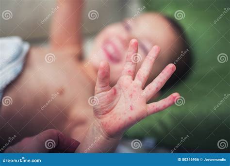 Boy With Symptoms Hand Foot And Mouth Disease Stock Photo Image Of