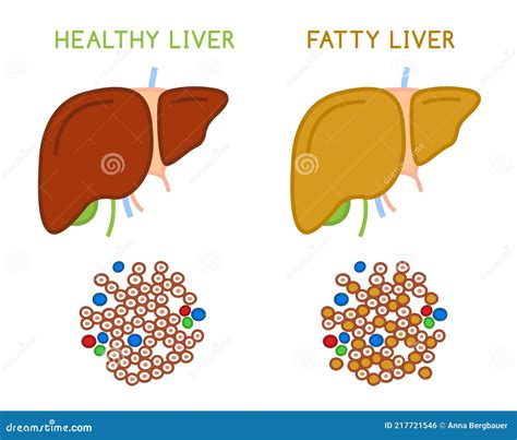 Healthy And Fatty Liver Medical Vector Infographic Stock Vector