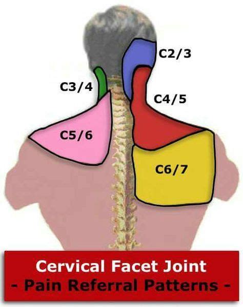 Cervical Facet Joint Pain Referral Patterns Health Stuff For
