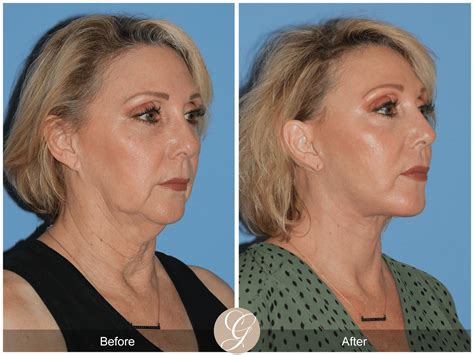 Deep Plane Facelift And Deep Plane Necklift Case 3 Before After Photos