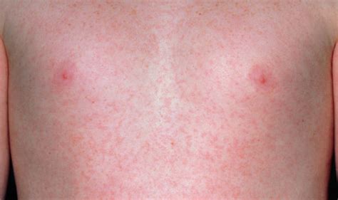 Measles Outbreak What Does The Rash Look Like Four Symptoms To Watch
