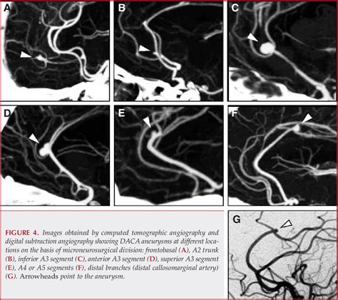 Angiographic Features Of Some Distal Anterior Cerebral Arteries My