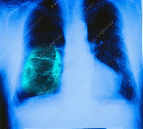 Asbestosis X Ray Stock Image C0309274 Science Photo Library