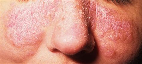 Lupus Rash Pictures Symptoms Causes Treatment Hubpages
