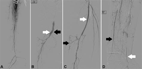 Retrograde Deep Femoral Artery Puncture For The Treatment Of An