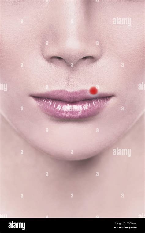 Cold Sore Blister Red Pimple On Upper Lips Of Woman With Herpes Design