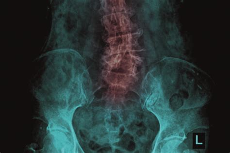 Nsaids Associated With Significant Improvement In Chronic Low Back Pain