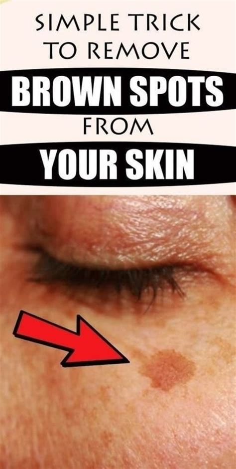 Simple Trick To Remove Brown Spots From Your Skin Wellness Herbal