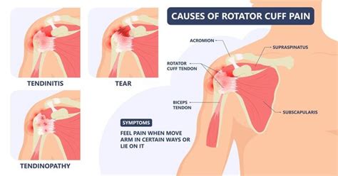 Subdeltoid Bursitis